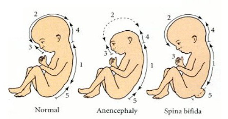 Diagram of normal, anencephaly, and spina bifida fetal development