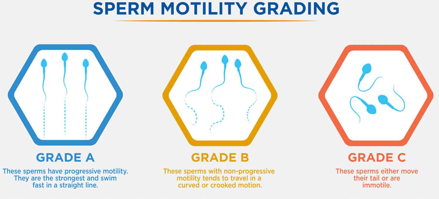 Sperm motility grading diagram showing Grades A, B, and C sperm movement patterns