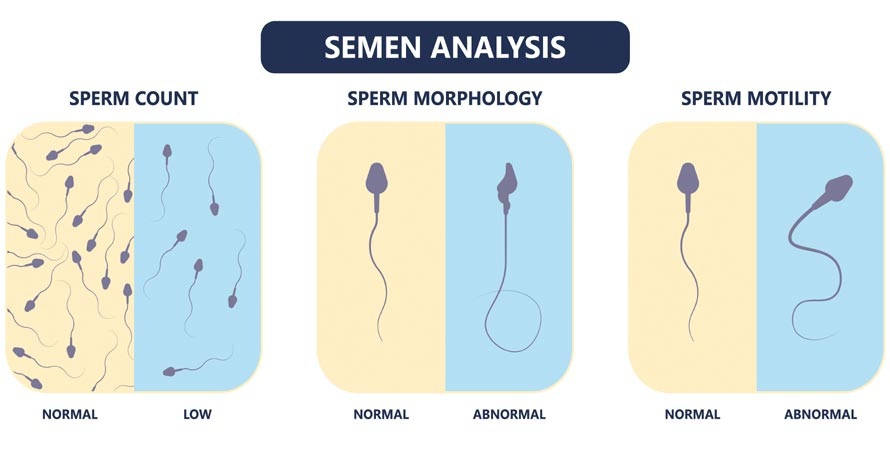 Semen analysis diagram showing sperm count, sperm morphology, and sperm motility with normal and abnormal examples.